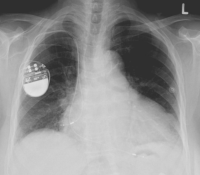 Pacemaker Treatment Explained