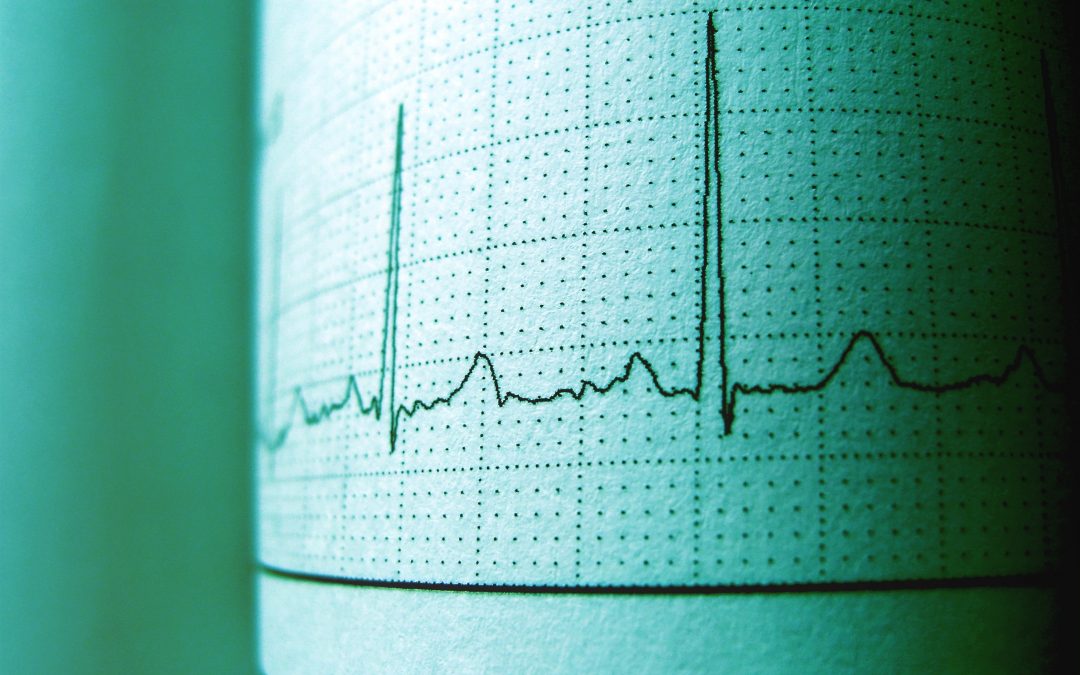 What are Palpitations?